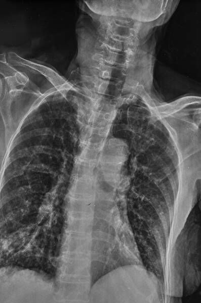 spinal subluxation xray