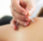trigger point injection