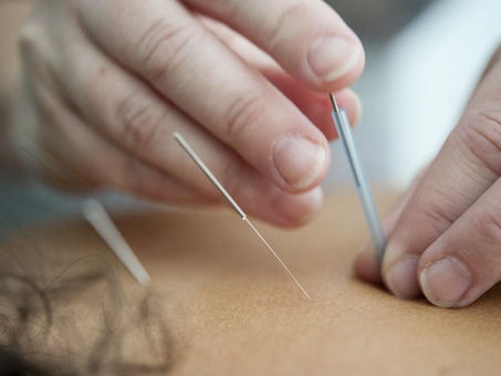 Dry Needling Vs. Acupuncture