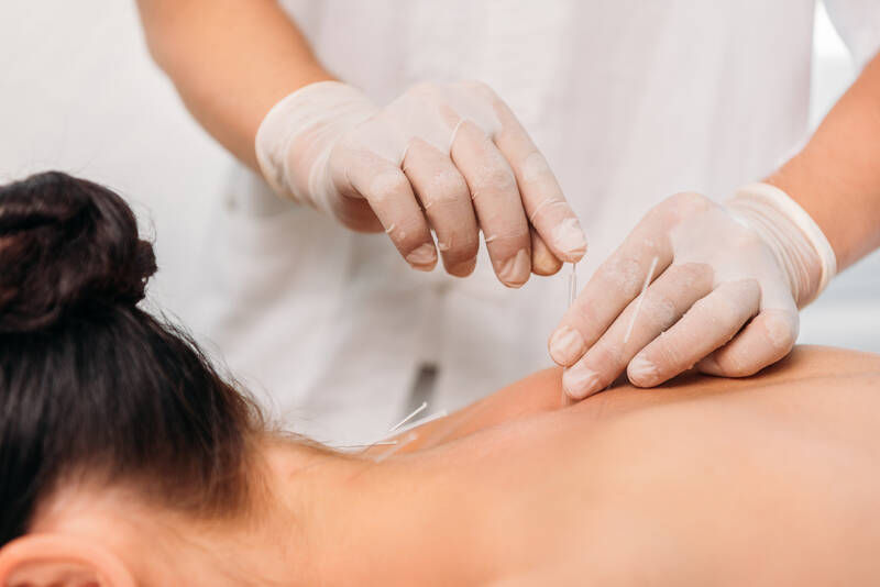 acupuncture for pain relief