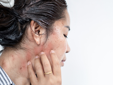 Allergic reaction to hair dye