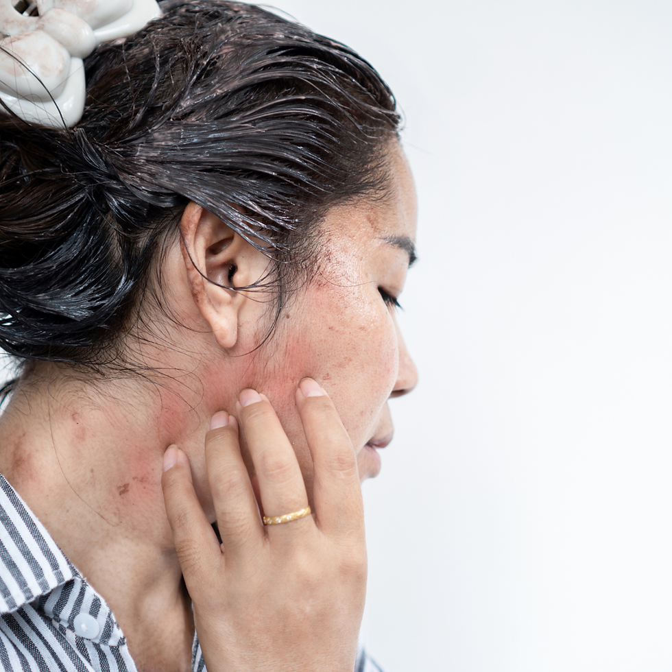 allergic reaction to hair dye