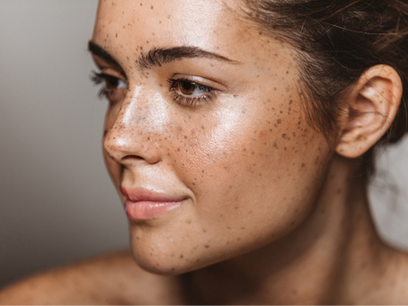 What Are Freckles & What Causes Them?