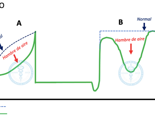 Asincronías de la ventilación mecánica - Parte 2
