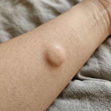 create bump on the skin on the arm, make it larger and less red.jpg