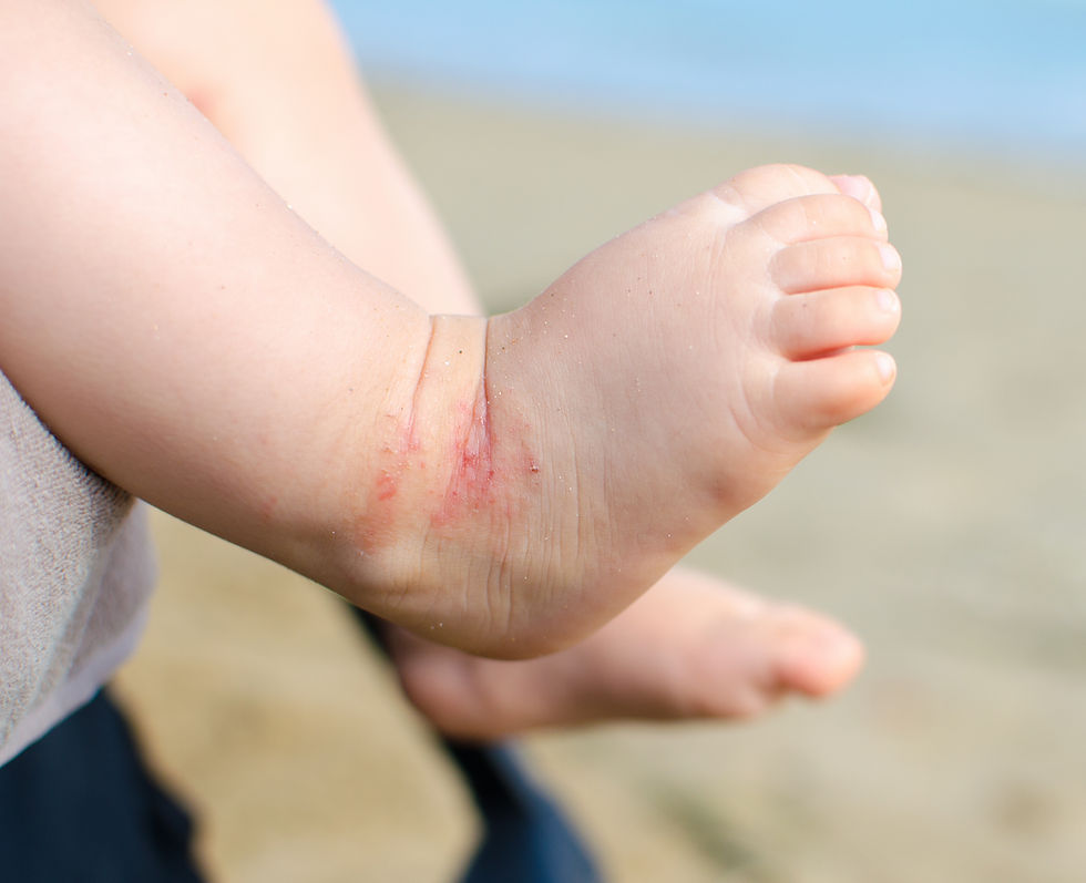 A DAD’S BATTLE AGAINST ECZEMA