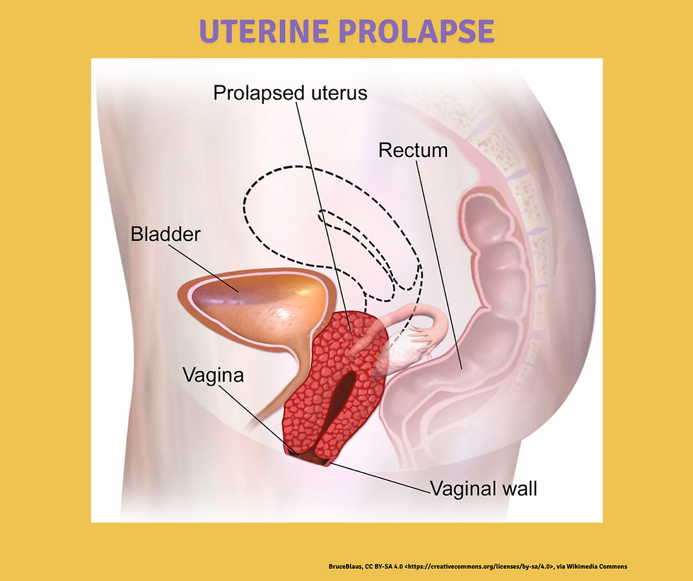 Picture of a uterine prolapse. Text reads: Uterine Prolapse.