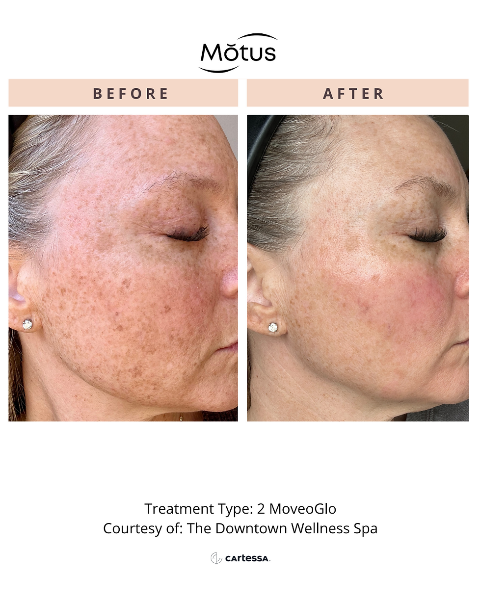 Two MoveoGlo Treatments