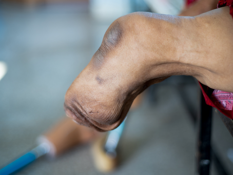 Amputee gently touching their residual limb while managing phantom limb sensations at home.
