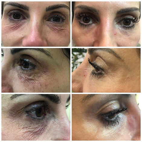 Palpebral I B&A.jpeg