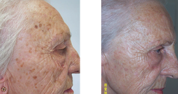 Melanosis 3