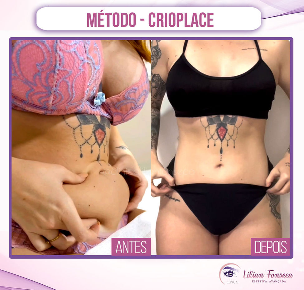 Metodo-Crioplace.jpg
