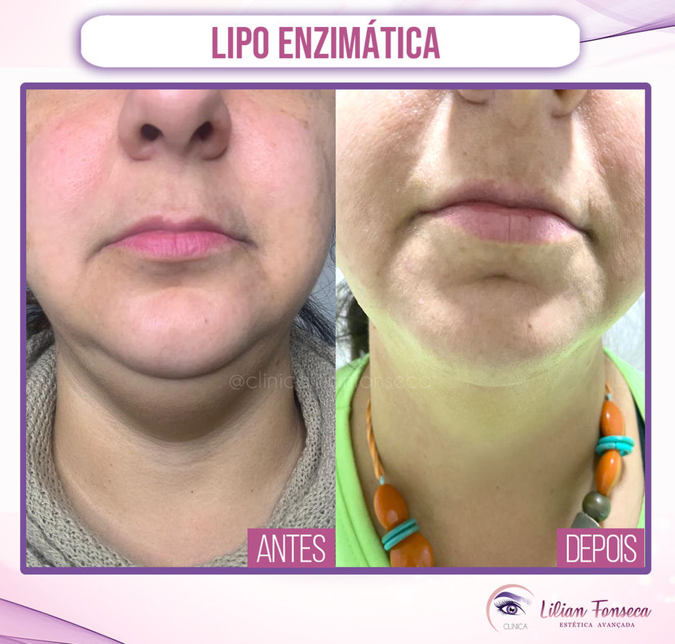 Lipo-Enzimática.jpg
