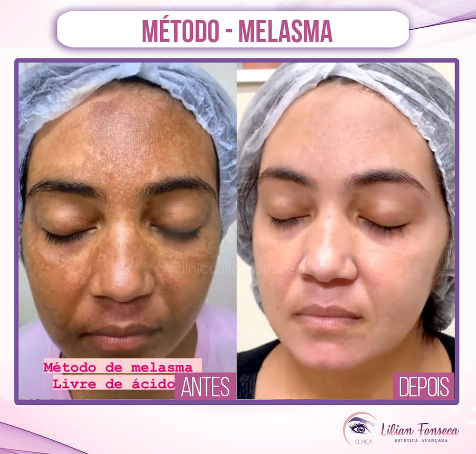 Melasma.jpg