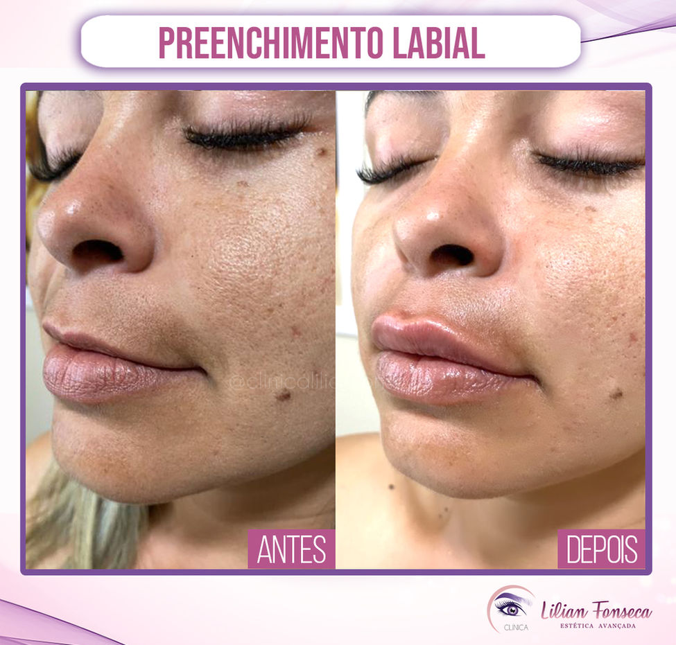 Preenchimento-Labial.jpg