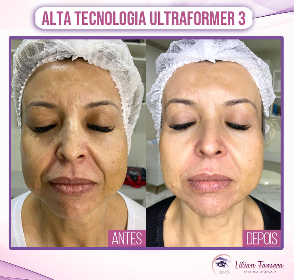 Ultraformer 3 - 2.jpg