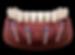all-on-4-3-300x218.jpg