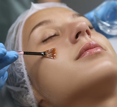 Chemical Peel photo for web.jpg