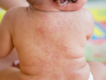 Baby with red rash on back, seated on colorful mat. Skin irritation visible; setting is bright and soft. No text present.