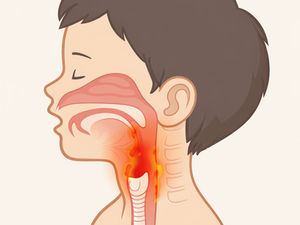 Diagram showing airway swelling in croup causing barking cough in toddlers