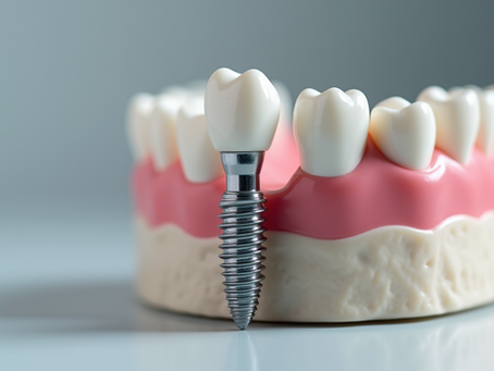 Dental Implants vs Dentures A Comprehensive Guide to Choosing the Right Option for Your Smile