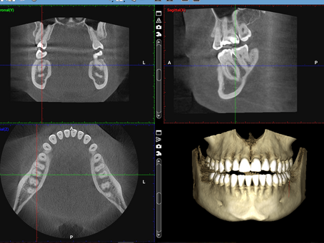 Revolutionizing Dental Implant Planning with CBCT Imaging