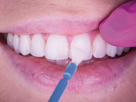 The Remarkable Benefits of Fluoride Varnish in Preventative Dental Care