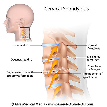 Cervical Spondylosis | Sportkinetics Mechelen