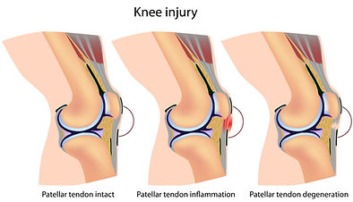 Kniepijn, revalidatie, Sportkinetics, sportkinesitherapie, knieblessure, kinesitherapie, patellapeesontsteking, patellapees tendinose, patellapees tendinopahtie, jumpers knie, jumpers knee.
