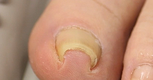 Why the course of antibiotics you took didn’t get rid of your ingrown