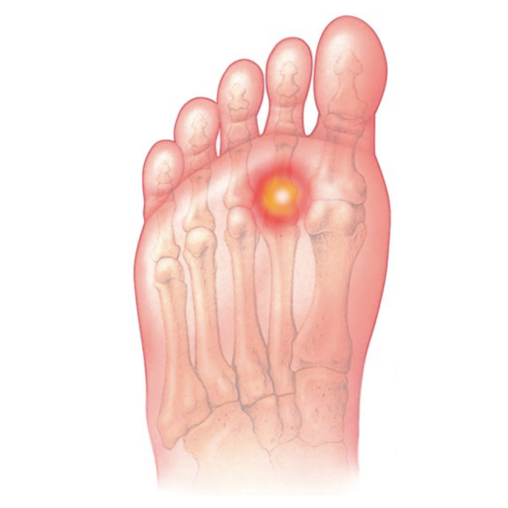 Pain in the ball of your foot?