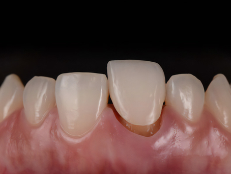 Cách dán răng giả bị rớt tạm thời tại nhà an toàn nhất là gì?