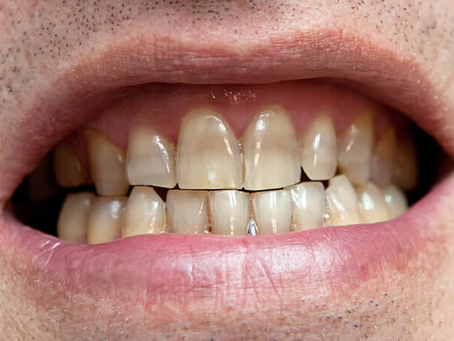 Giá tẩy trắng răng cho người bị nhiễm màu kháng sinh nặng tetracycline là bao nhiêu?