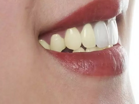 Bề mặt sứ bị xước làm răng sứ có bị ố vàng không?