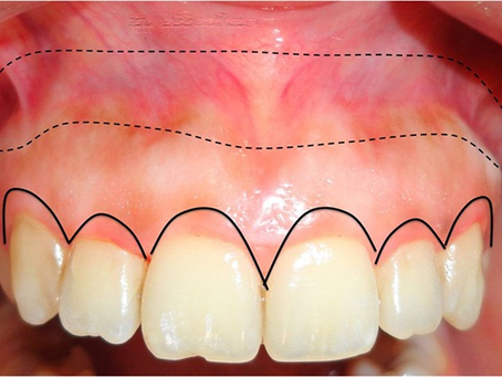 Viêm lợi sau khi bọc răng sứ có thể tự khỏi được không?
