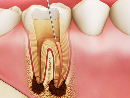 Lấy tủy bọc răng sứ trọn gói giá bao nhiêu tiền?