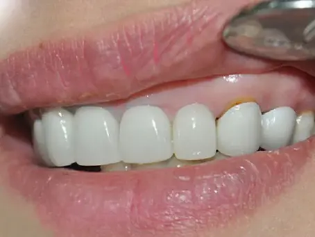 bọc sứ bị đen nướu