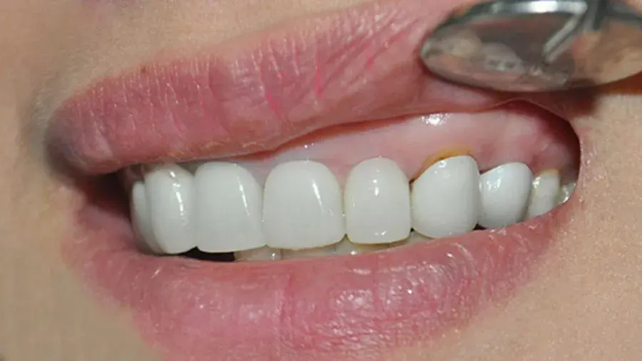 Bọc răng sứ bị hở
