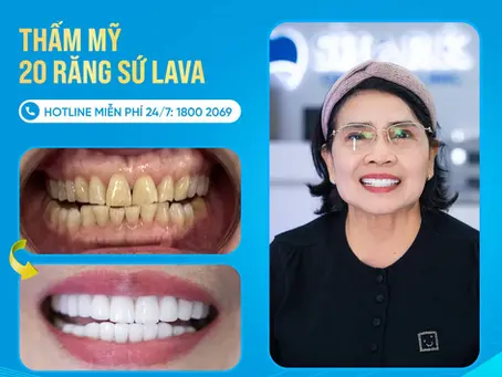 Răng sứ Mỹ