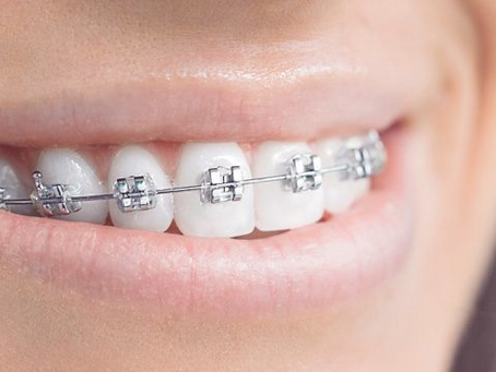 Discover the Best Braces for You