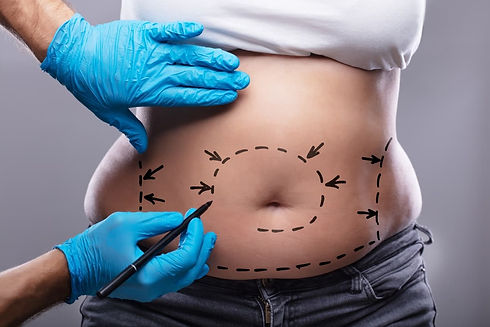 Karın Germe (Abdominoplasty)