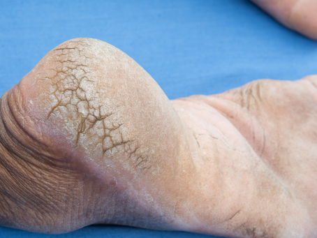 Cracked Heels - Causes, Prevention, and Effective Treatment
