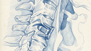Anterior Cervical Discectomy and Fusion - ACDF for Clinicians