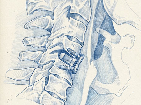 Anterior Cervical Discectomy and Fusion - ACDF for Clinicians