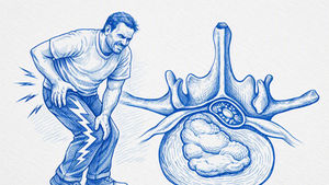 Lumbar radiculopathy for healthcare professionals