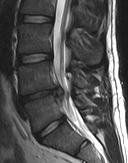 Eye-level view of ultrasound machine displaying spinal nerve imaging