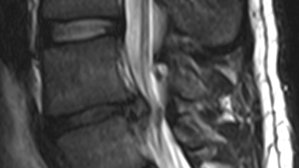 Understanding Sciatica: A Comprehensive Guide for Relief in Singapore