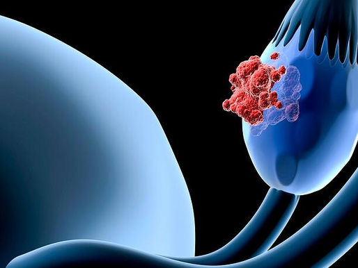 Cáncer de ovario