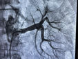 A 60-year-old male patient at Manipal Hospital Dhakuria underwent a successful laser-guided renal artery angioplasty