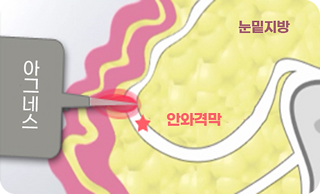 아그네스눈밑2.png